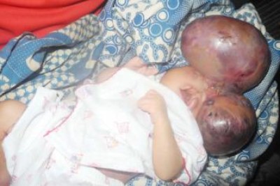 Deformed babies in Nigeria