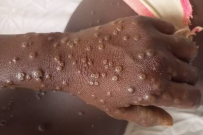 Lésions cutanées de mpox chez une enfant, à Bangui, en République centrafricaine, où circule le clade I du virus.